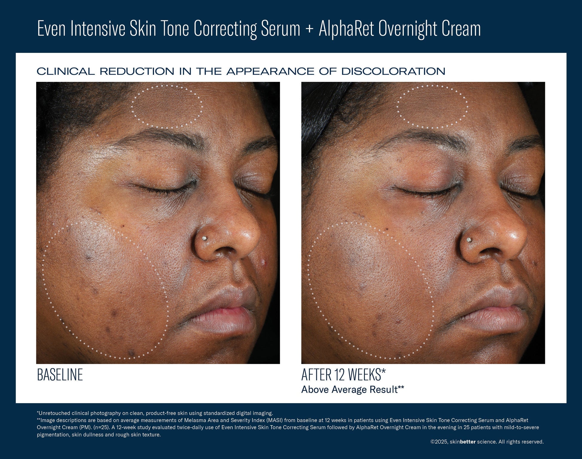 Even Intensive Skin Tone Correcting Serum 50 ml