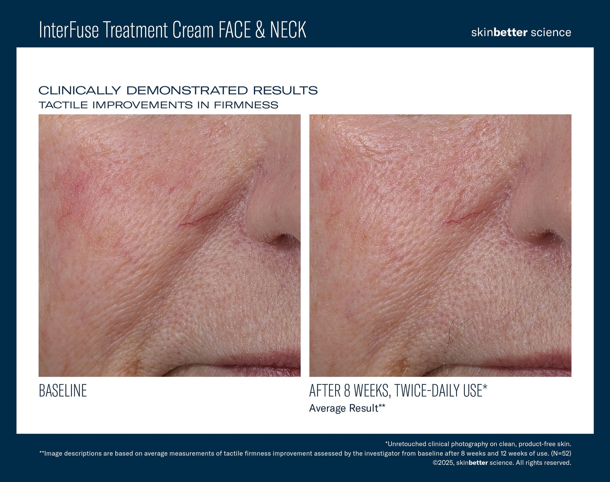 InterFuse Treatment Cream FACE & NECK 30 ml