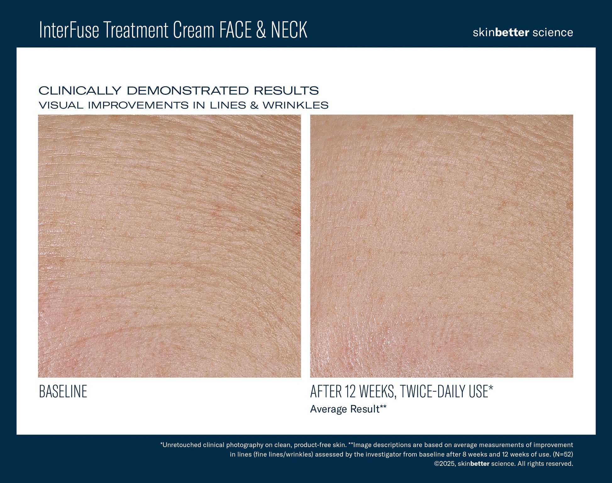 InterFuse Treatment Cream FACE & NECK 50 ml